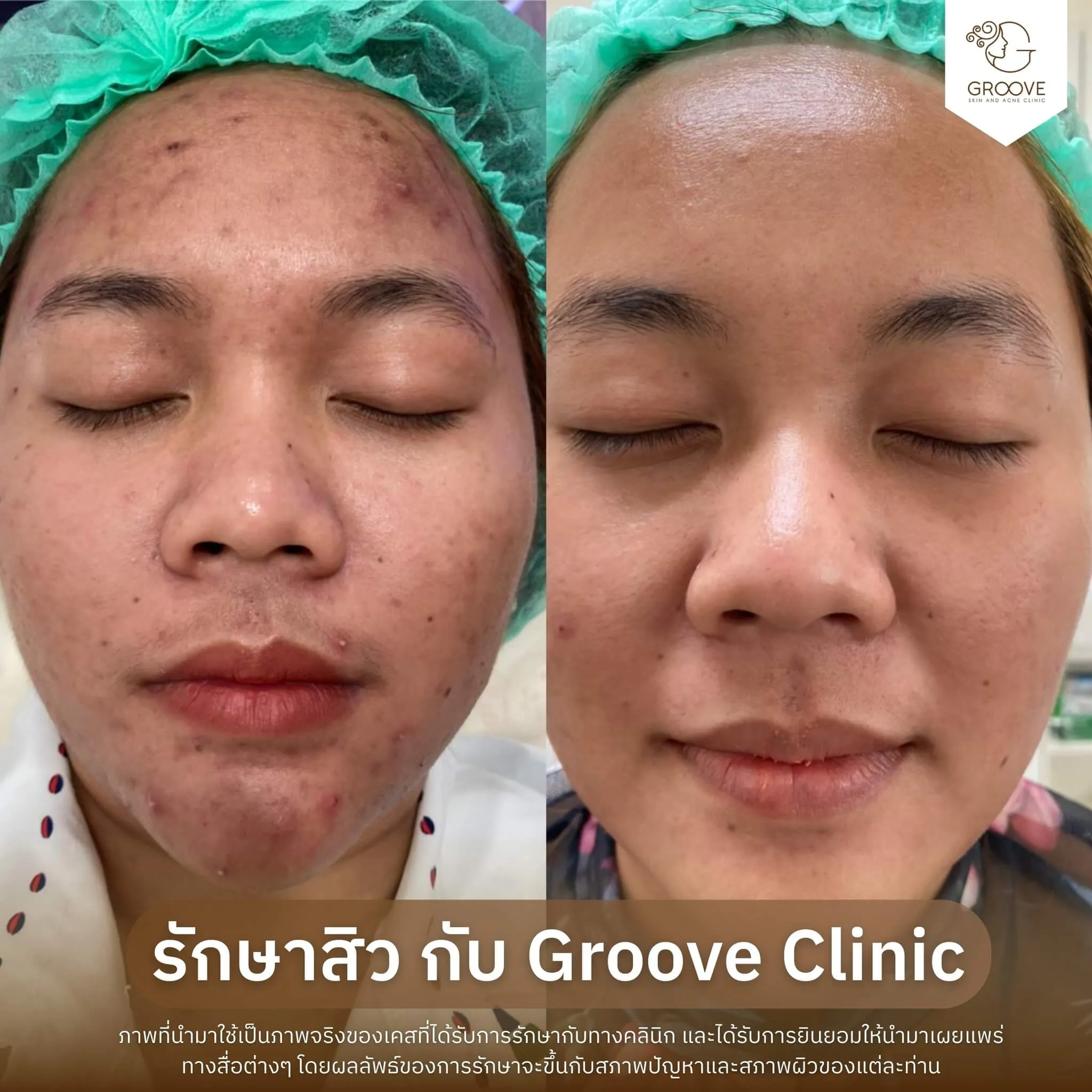 Before–After 13
