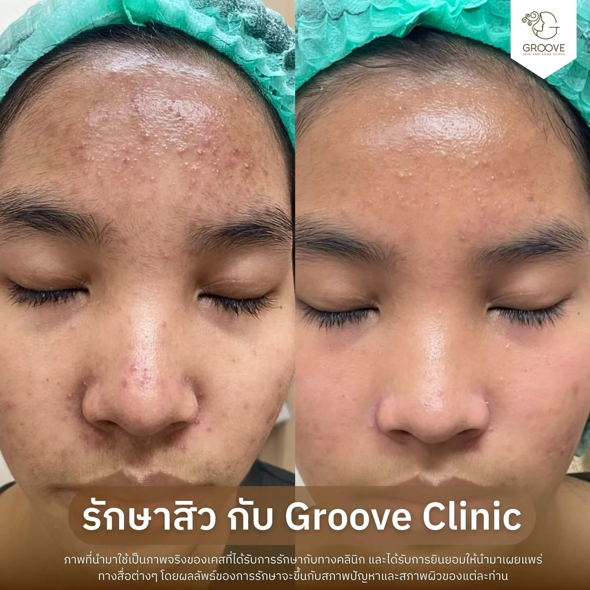 Before–After 14