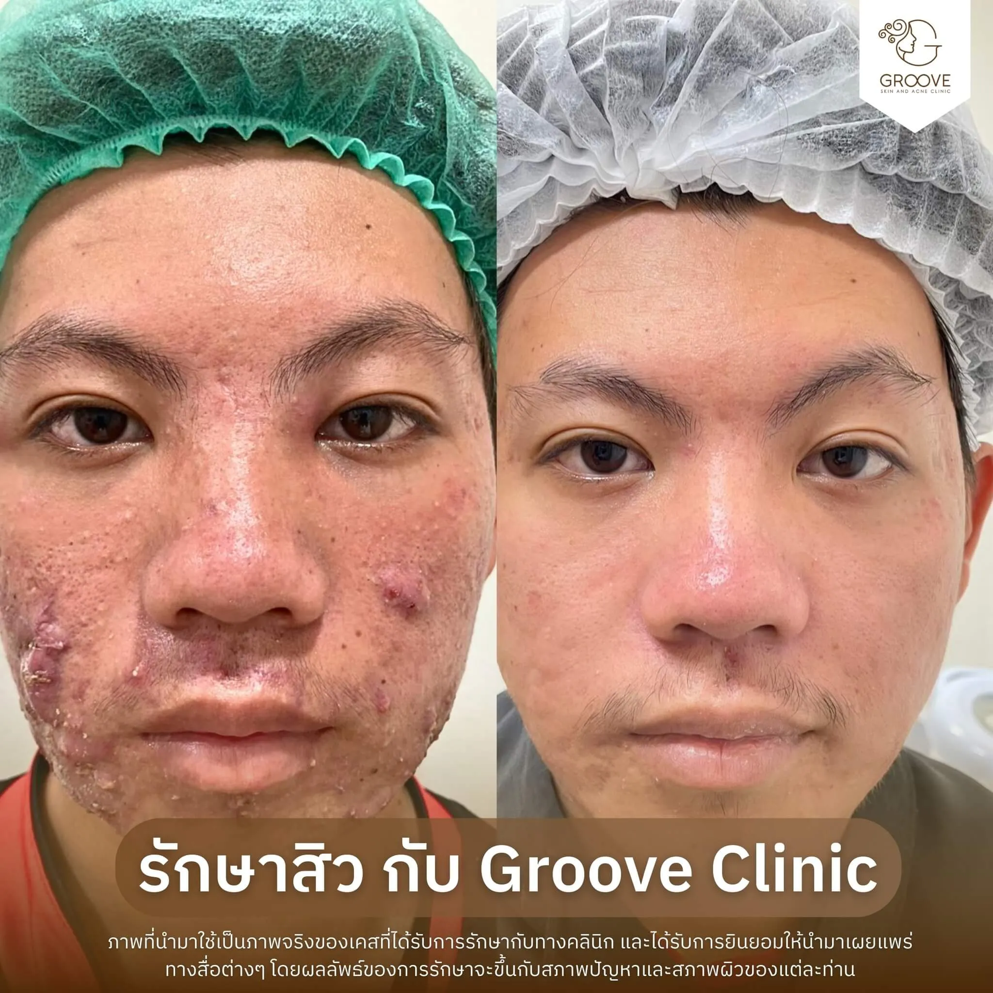 Before–After 2