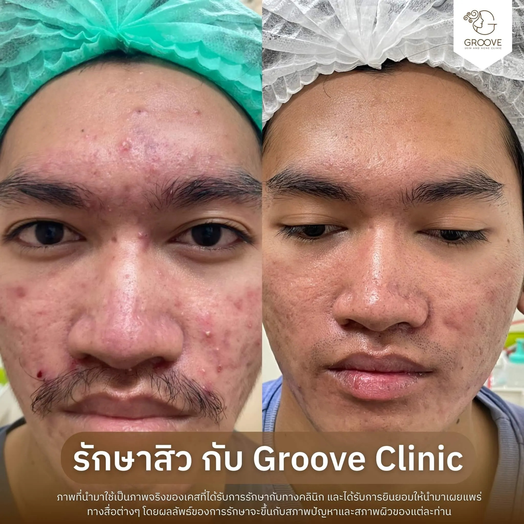 Before–After 6