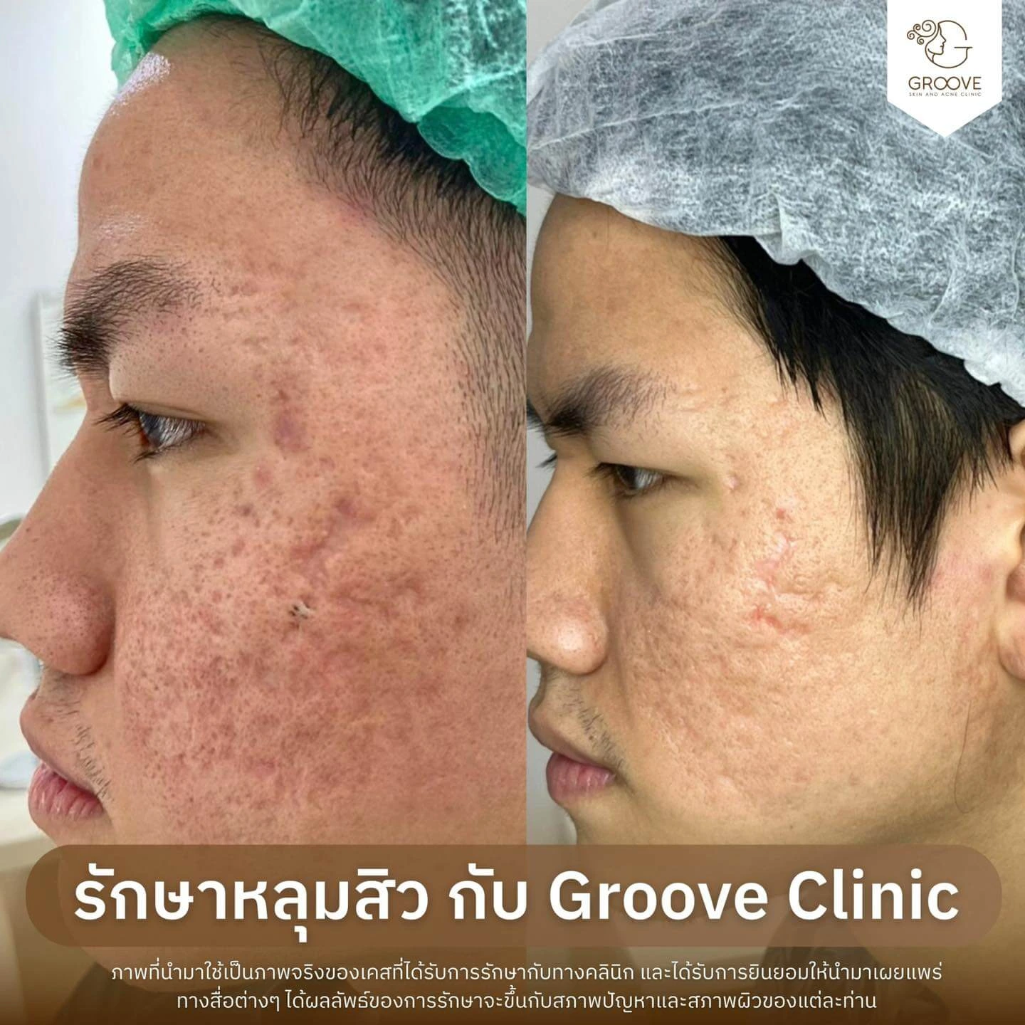 Before After รักษาหลุมสิว Groove Clinic 1