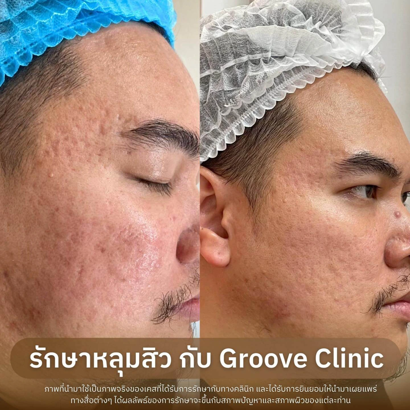 Before After รักษาหลุมสิว Groove Clinic 2