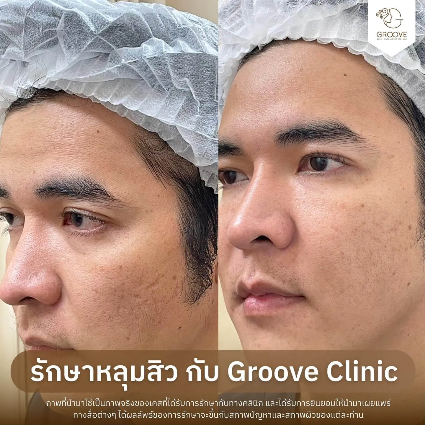 Before After รักษาหลุมสิว Groove Clinic 11