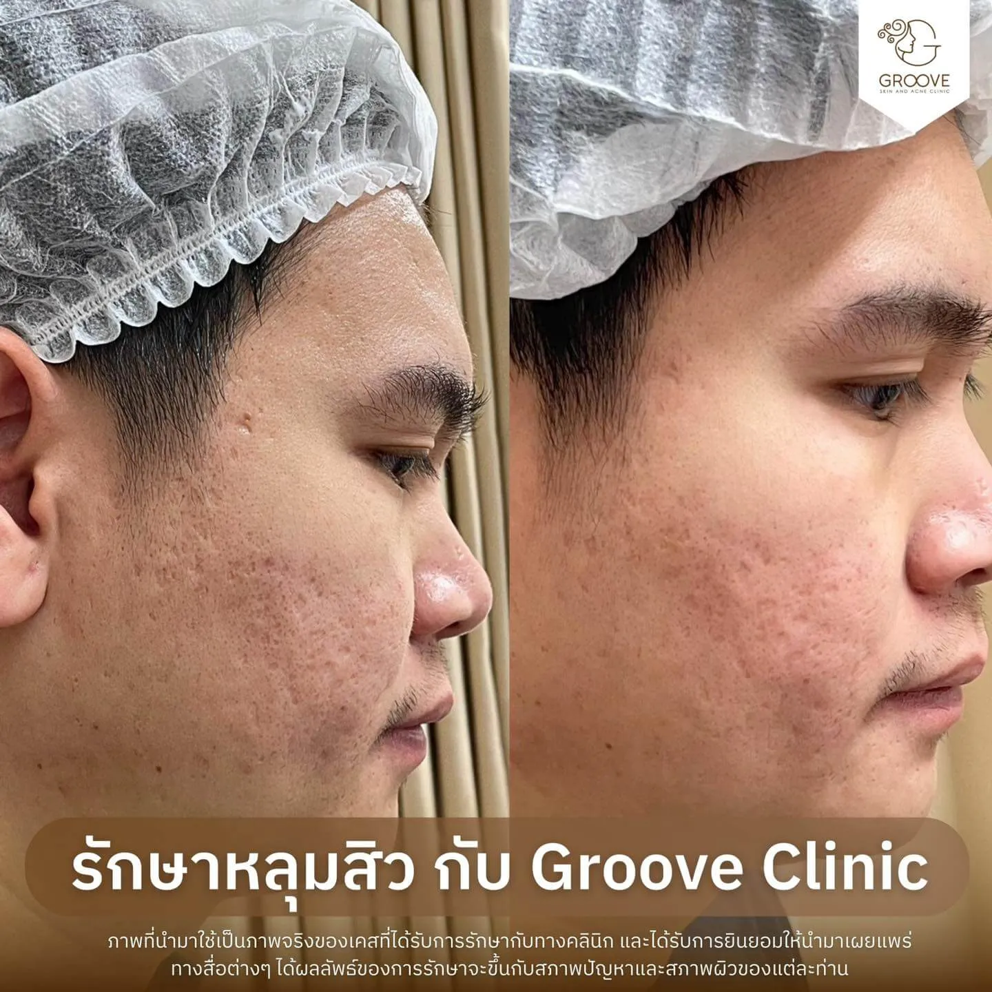 Before After รักษาหลุมสิว Groove Clinic 12