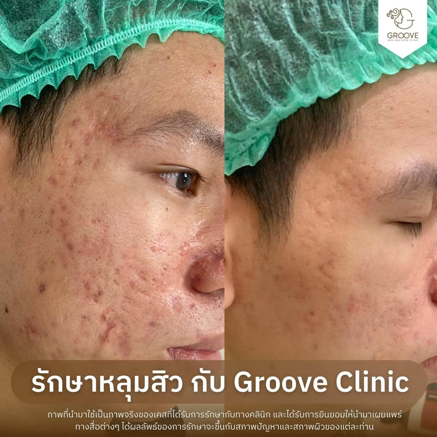 Before After รักษาหลุมสิว Groove Clinic 13
