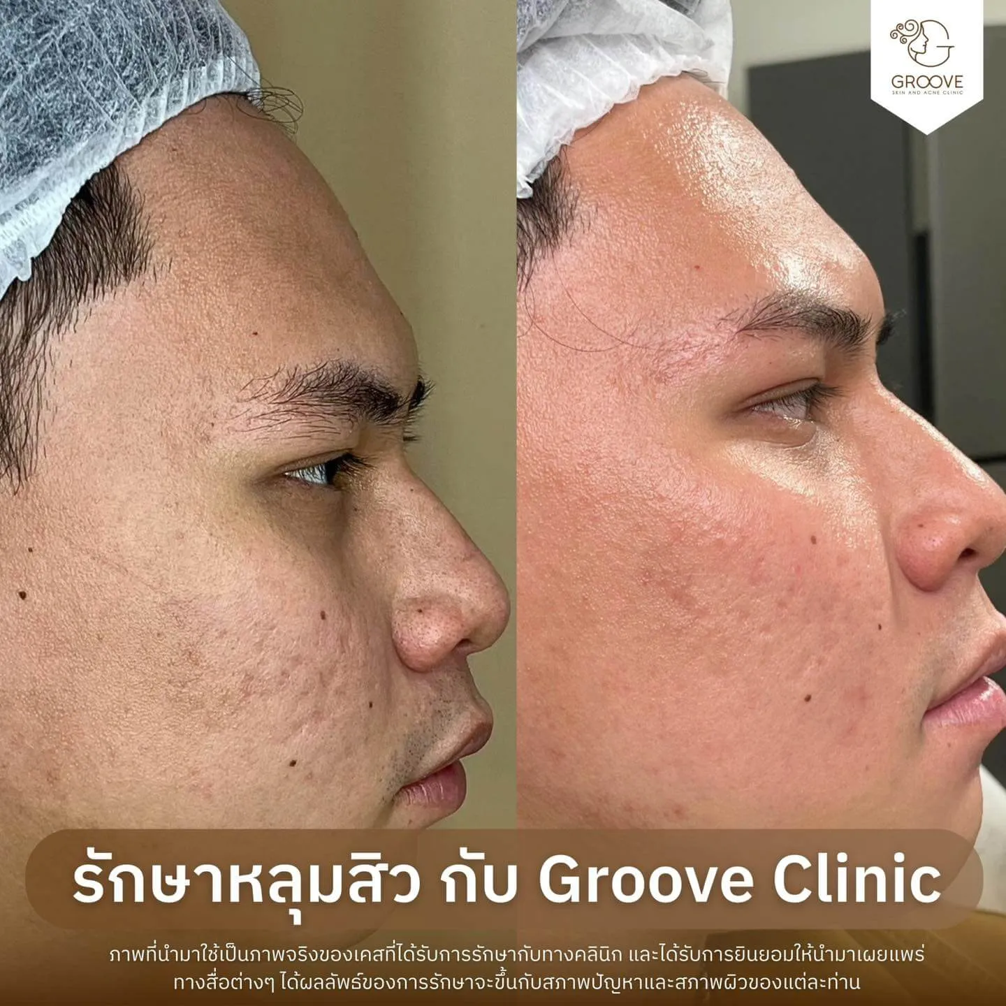 Before After รักษาหลุมสิว Groove Clinic 14