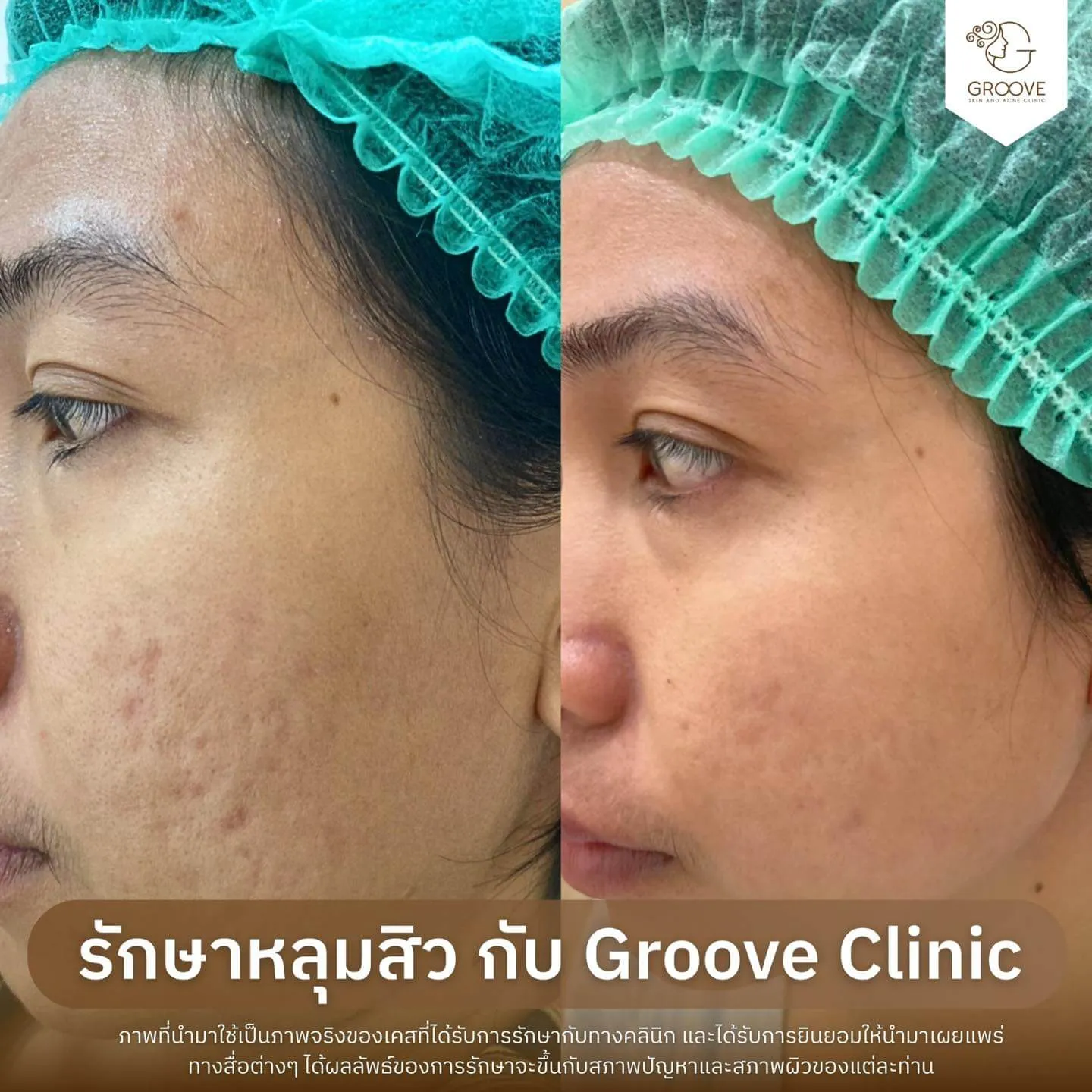 Before After รักษาหลุมสิว Groove Clinic 15