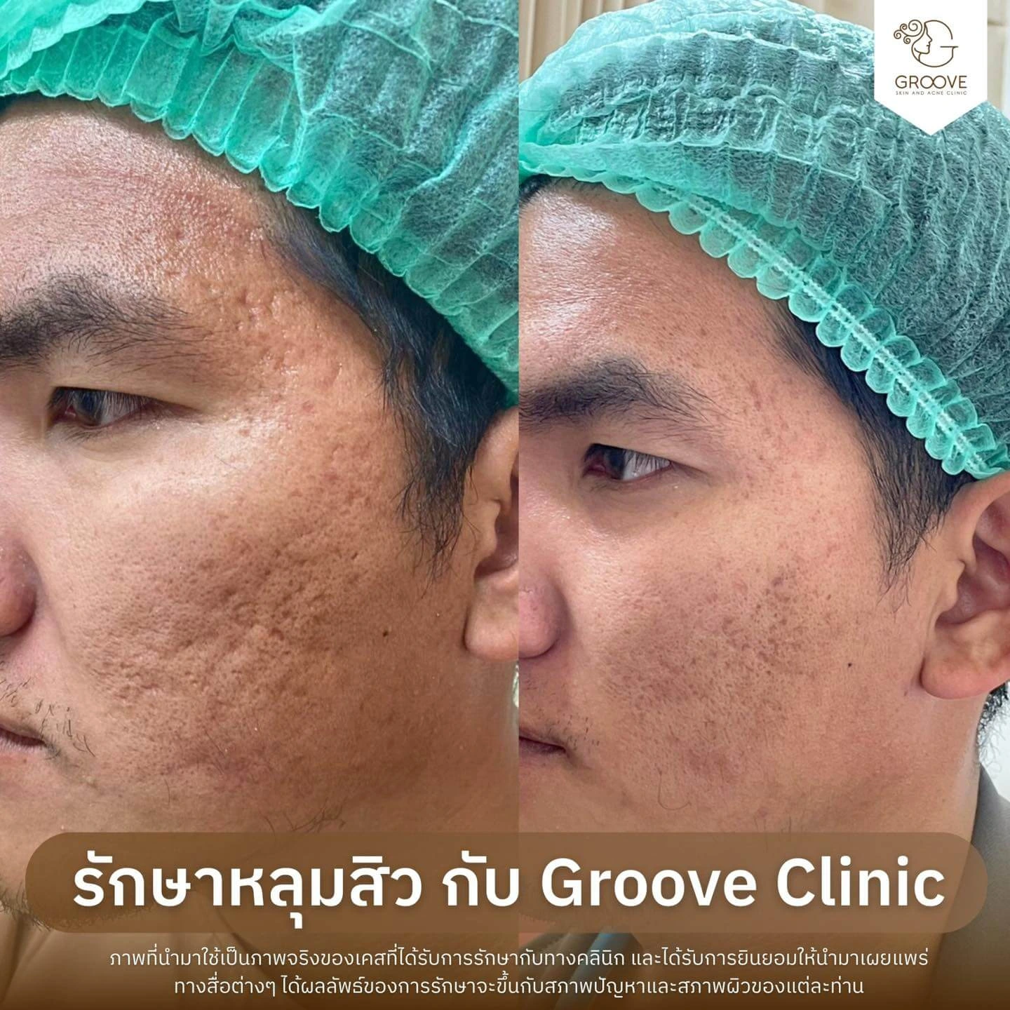 Before After รักษาหลุมสิว Groove Clinic 5