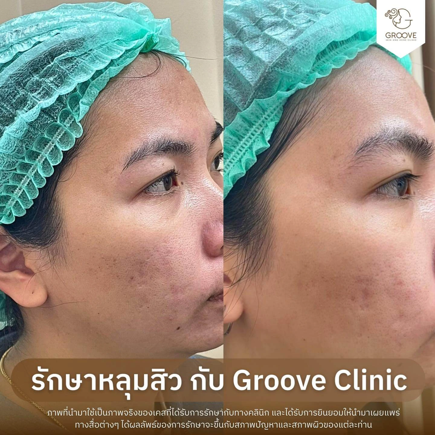 Before After รักษาหลุมสิว Groove Clinic 6