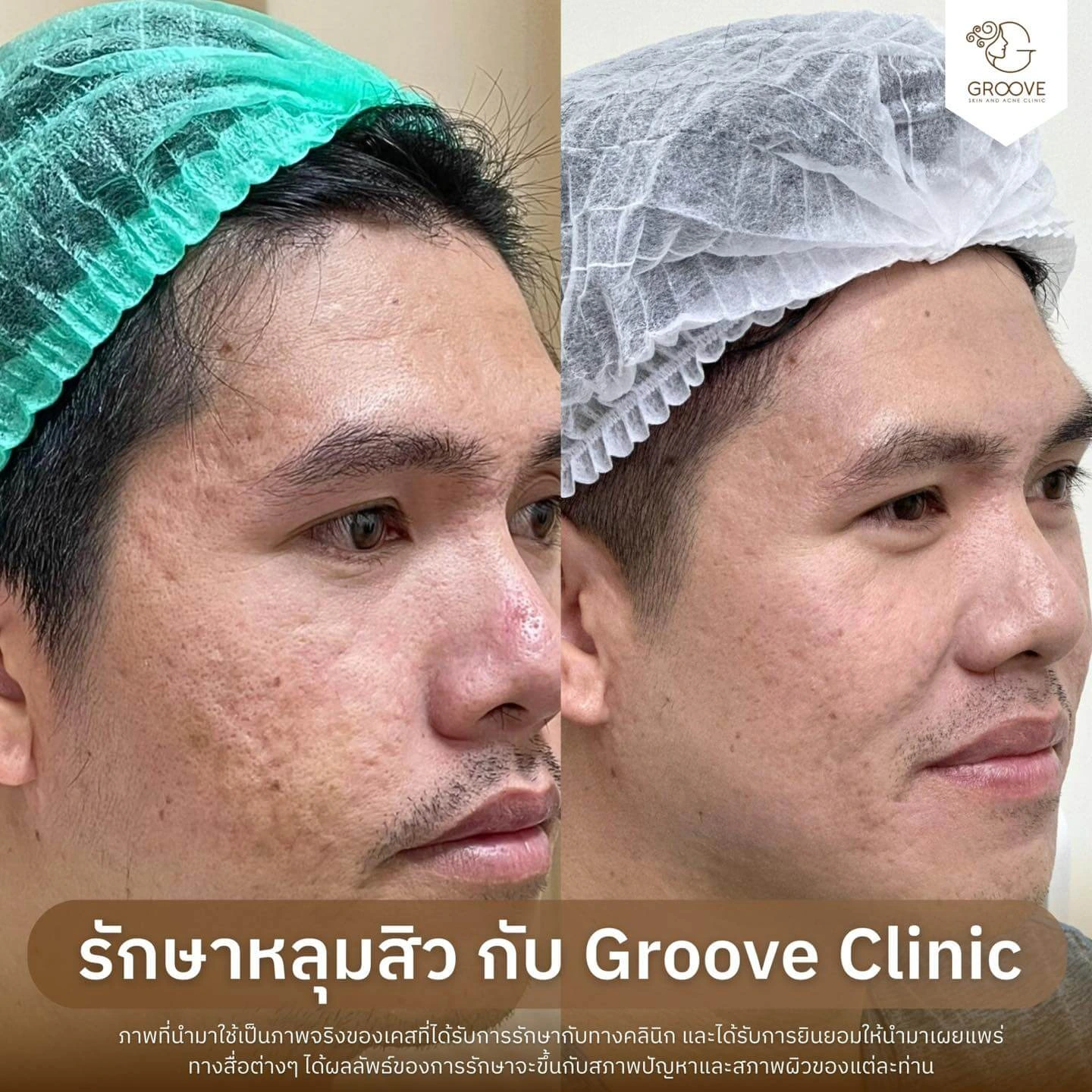 Before After รักษาหลุมสิว Groove Clinic 7