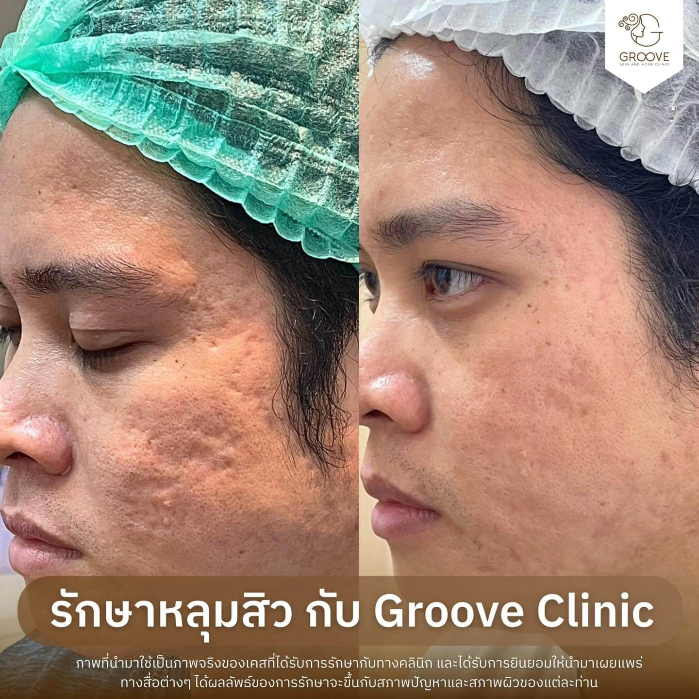 Before After รักษาหลุมสิว Groove Clinic 9