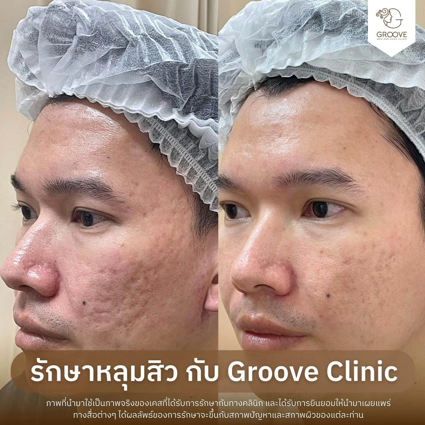 Before After รักษาหลุมสิว Groove Clinic 10