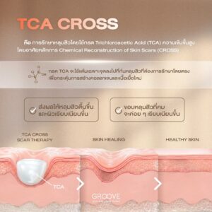TCA Cross รักษาหลุมสิว — Groove Clinic