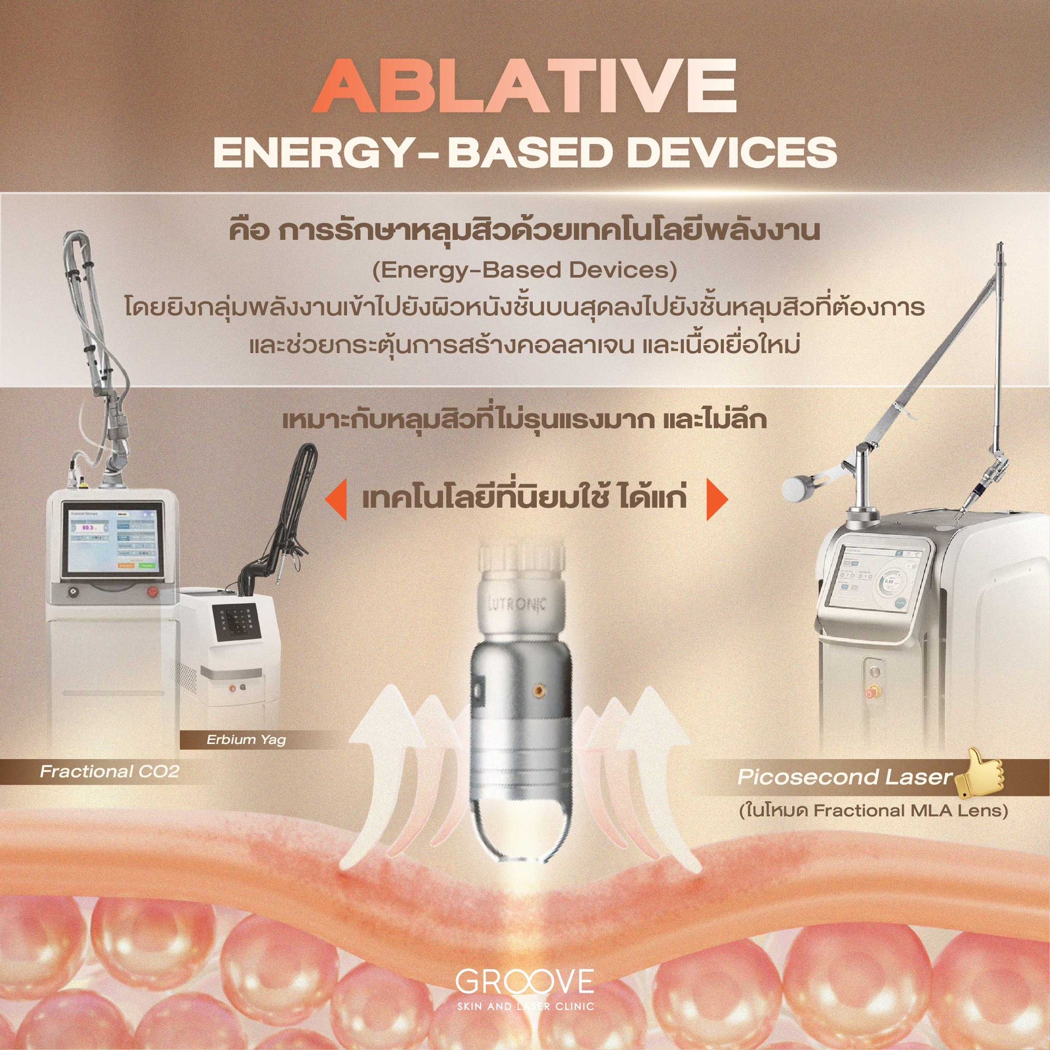 Ablative Energy-Based Devices เลเซอร์รักษาหลุมสิว