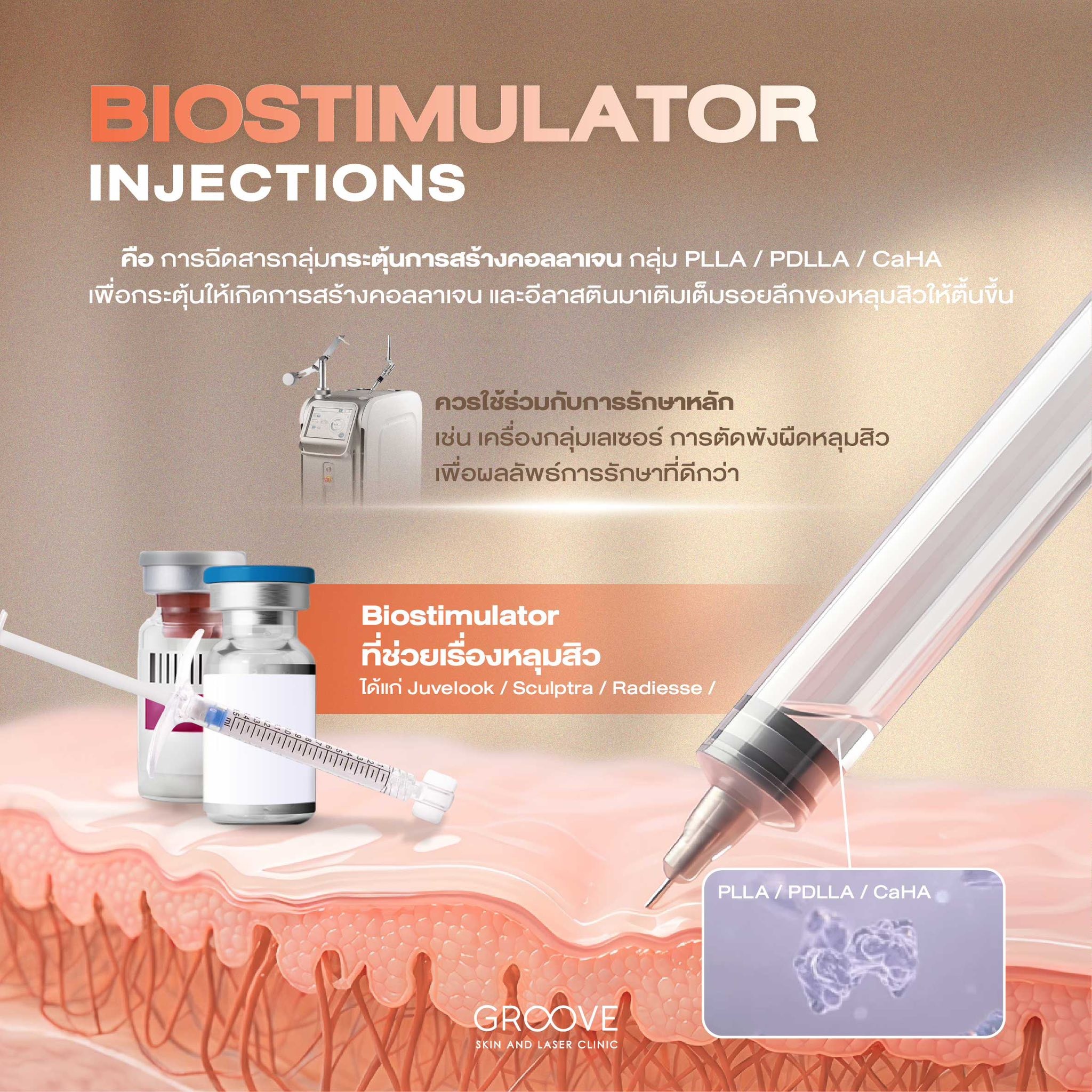 Subcision ตัดพังผืดหลุมสิว Groove Clinic