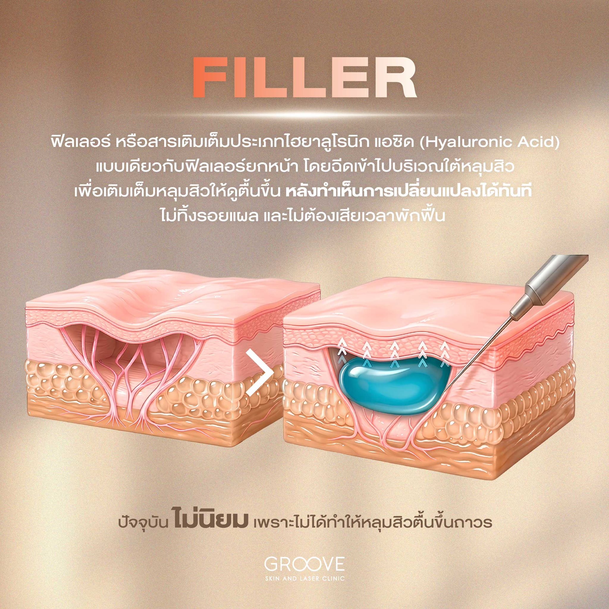 Filler เติมเต็มหลุมสิว Hyaluronic Acid