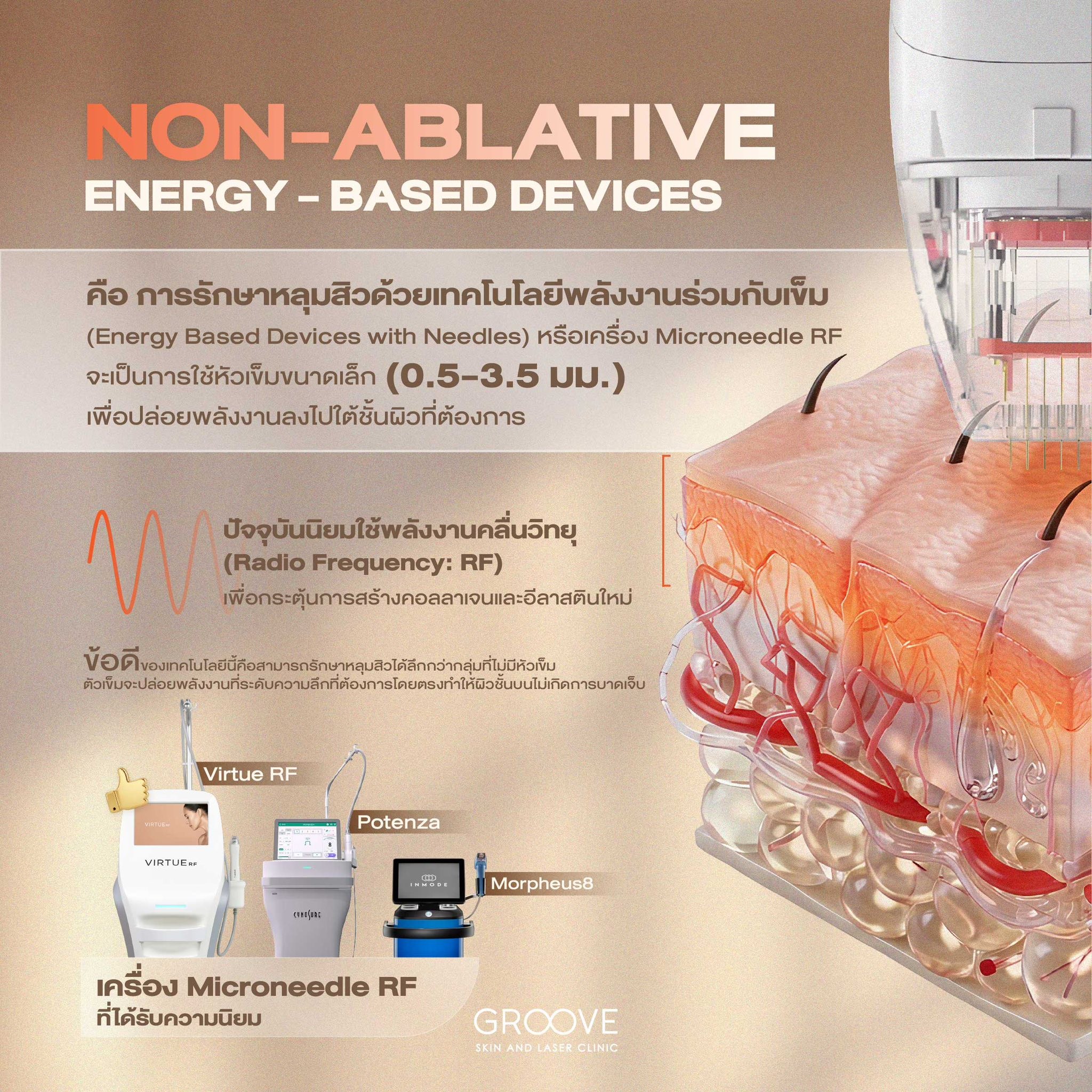 Non-Ablative Microneedle RF รักษาหลุมสิว