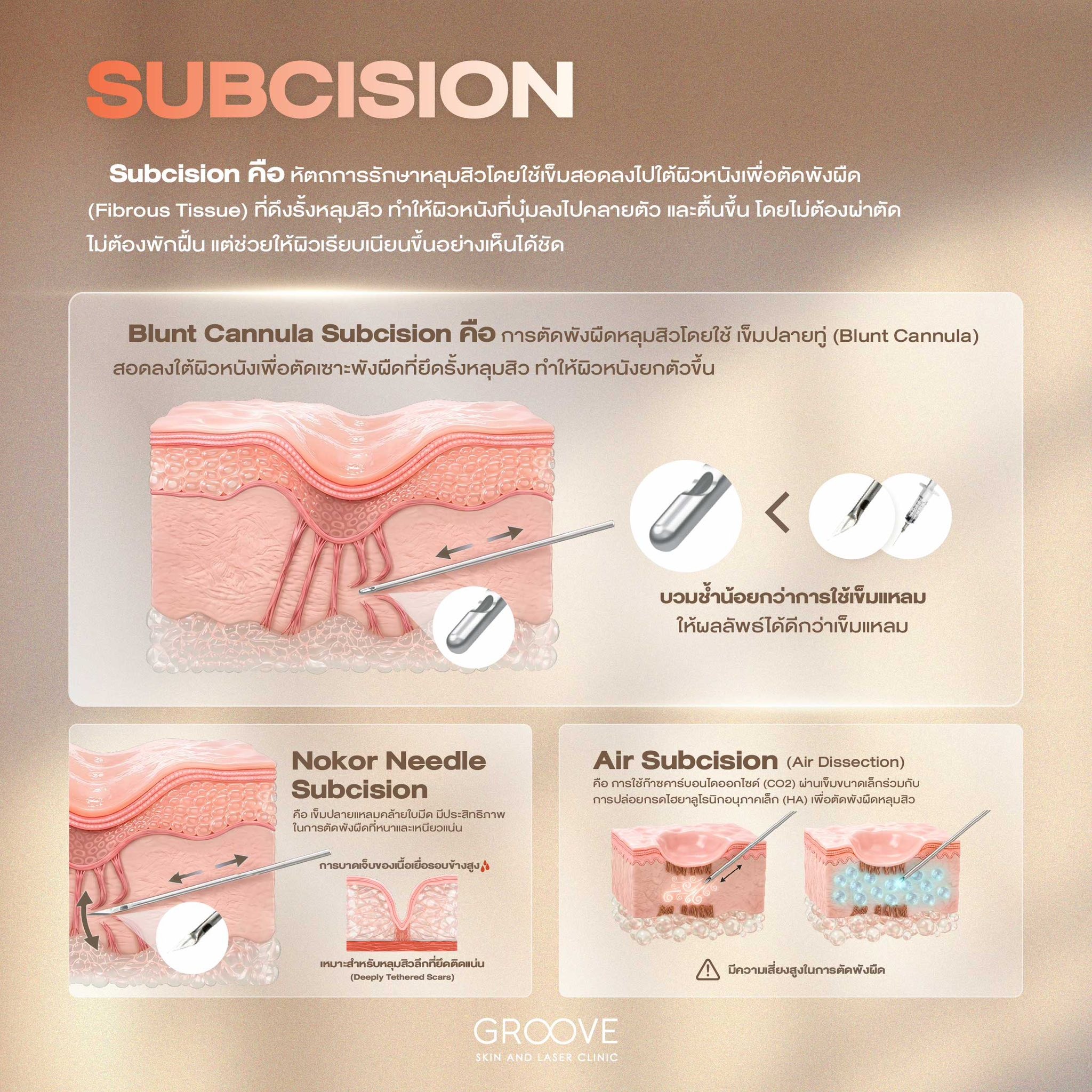 Biostimulator Injections PLLA PDLLA CaHA