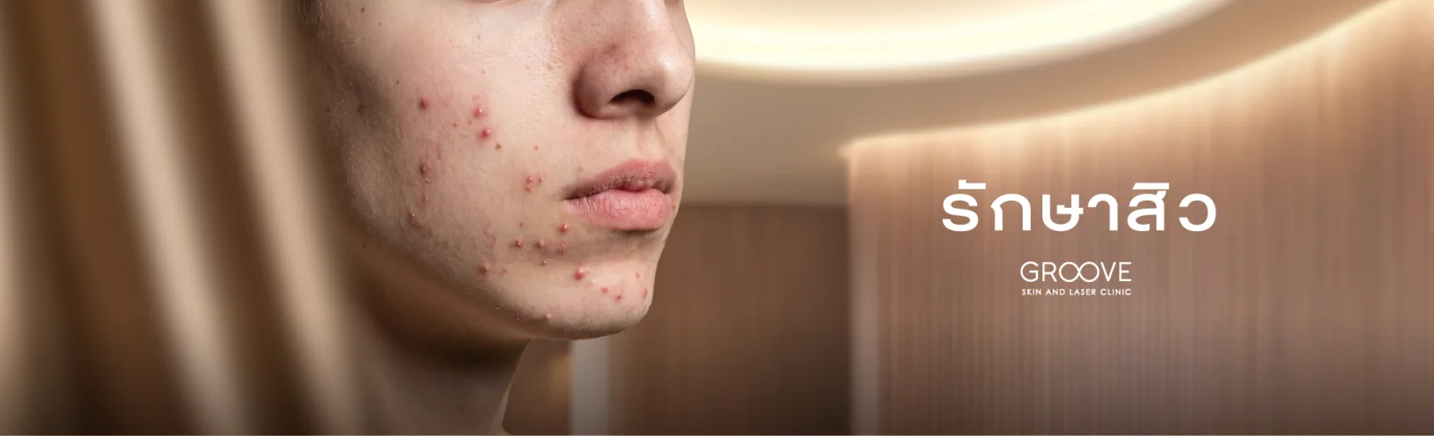 รักษาสิว — Groove Skin & Acne Clinic