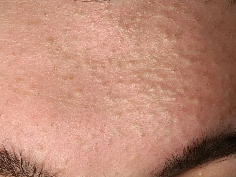 สิวหัวดำ (Blackheads) — Groove Skin Clinic สาขาม.เกษตร