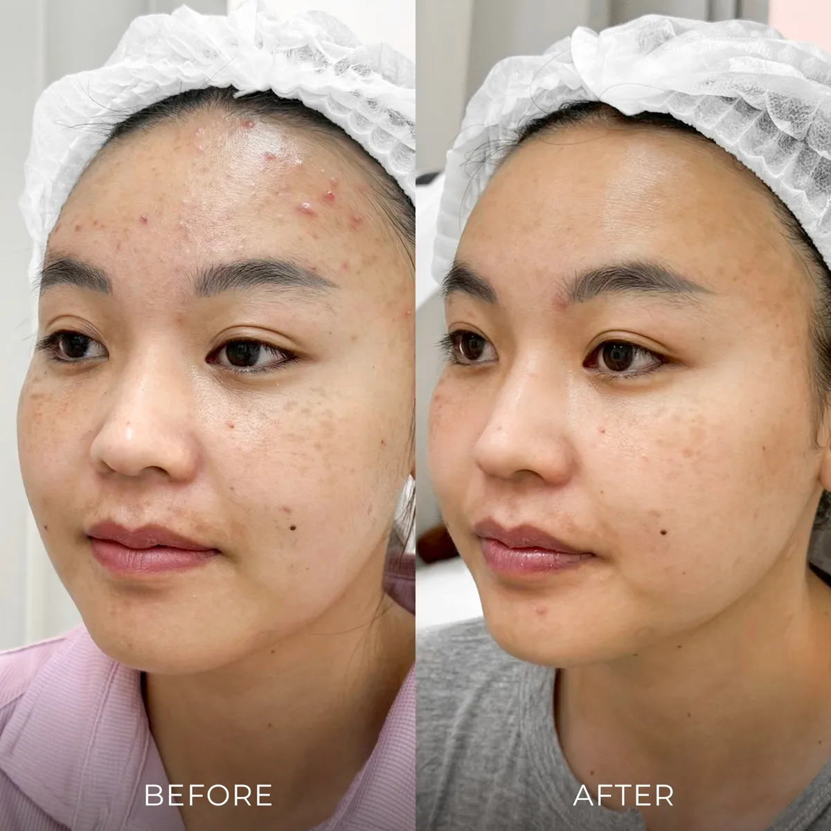 ภาพก่อน-หลังรักษาสิว Groove Skin Clinic เคส 01