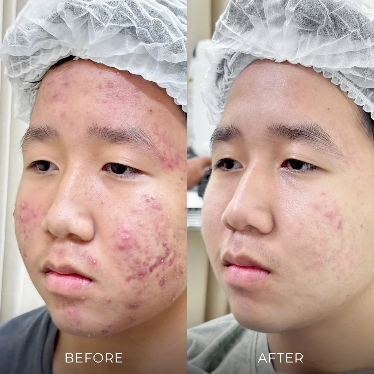 ภาพก่อน-หลังรักษาสิว Groove Skin Clinic เคส 02