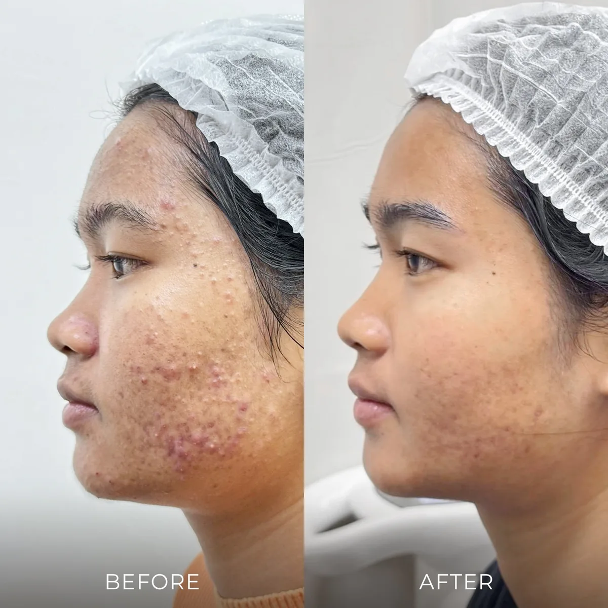 ภาพก่อน-หลังรักษาสิว Groove Skin Clinic เคส 03
