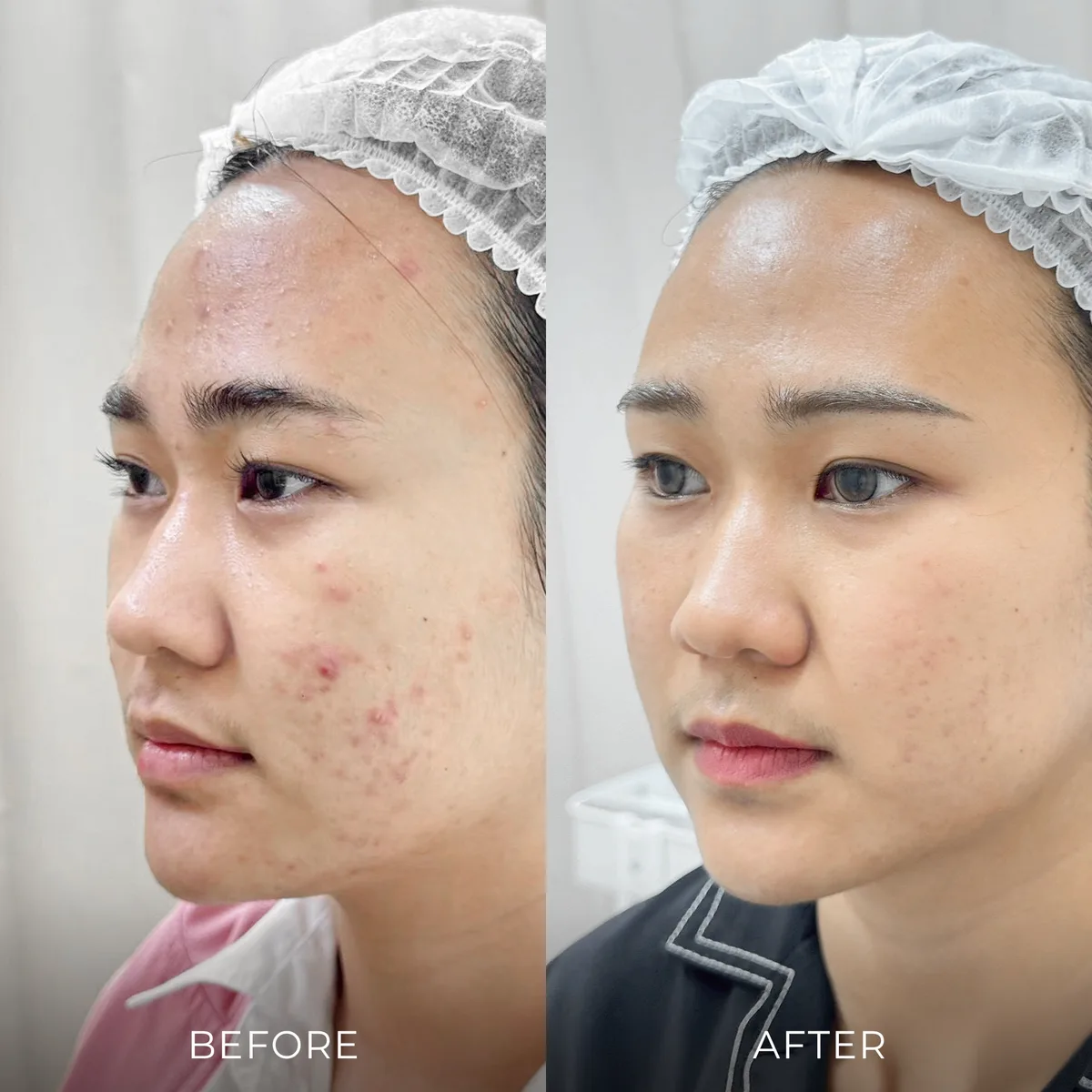 ภาพก่อน-หลังรักษาสิว Groove Skin Clinic เคส 04