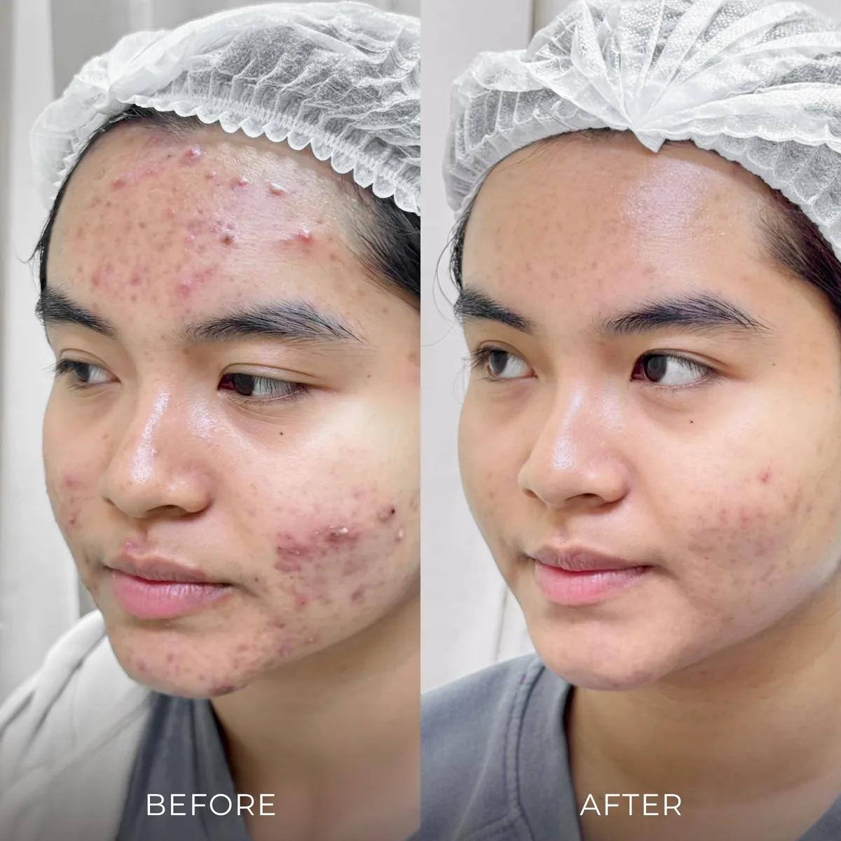 ภาพก่อน-หลังรักษาสิว Groove Skin Clinic เคส 05