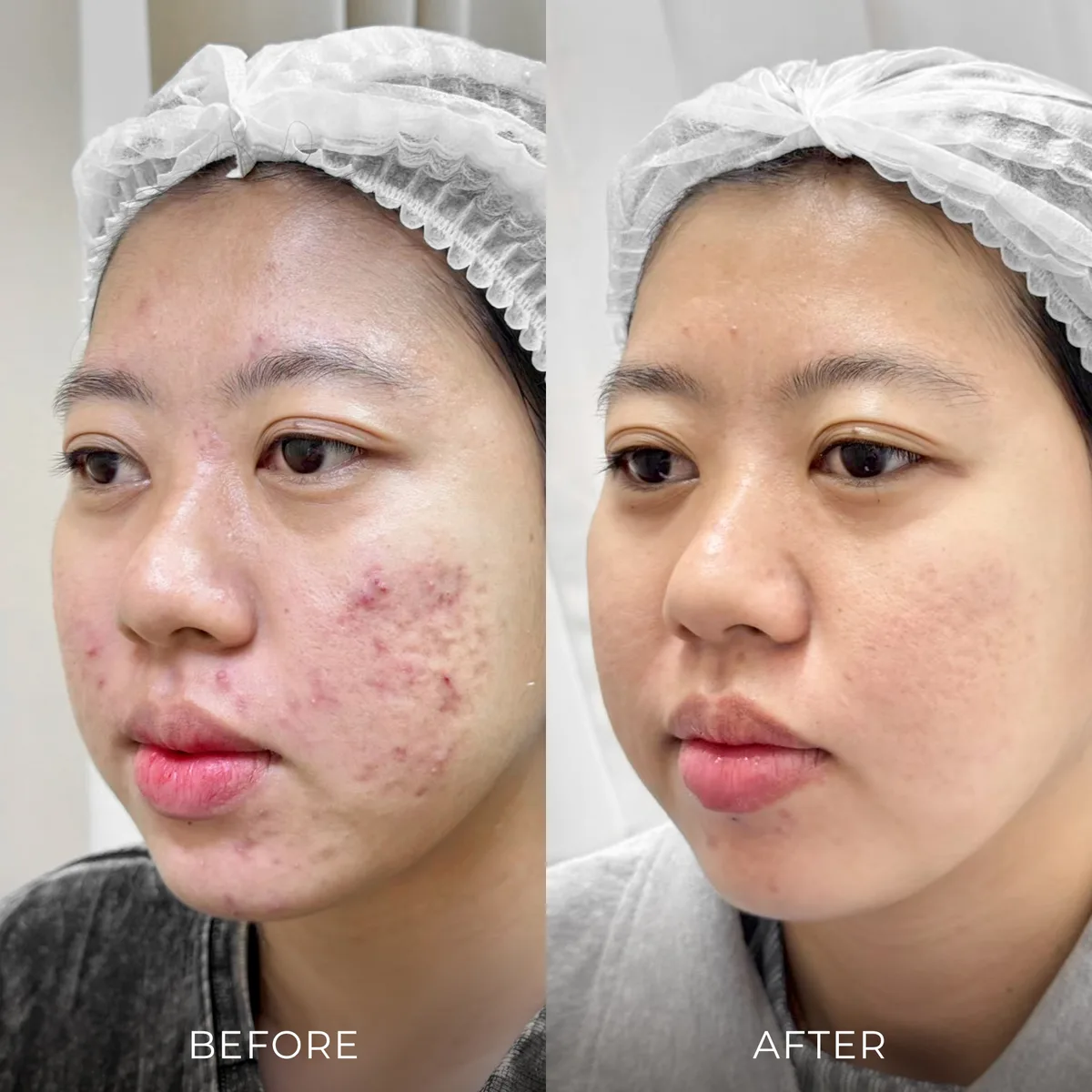 ภาพก่อน-หลังรักษาสิว Groove Skin Clinic เคส 06