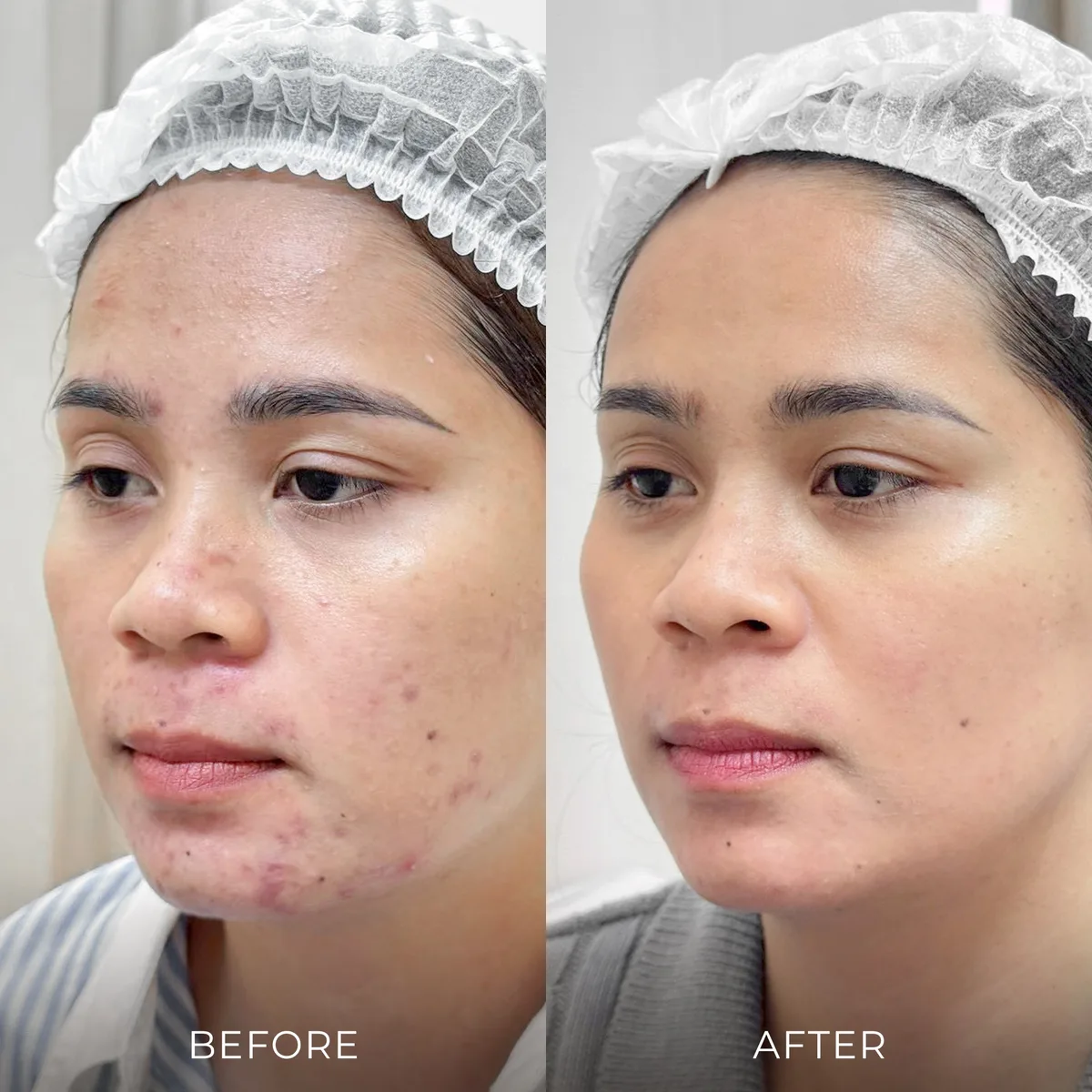 ภาพก่อน-หลังรักษาสิว Groove Skin Clinic เคส 07