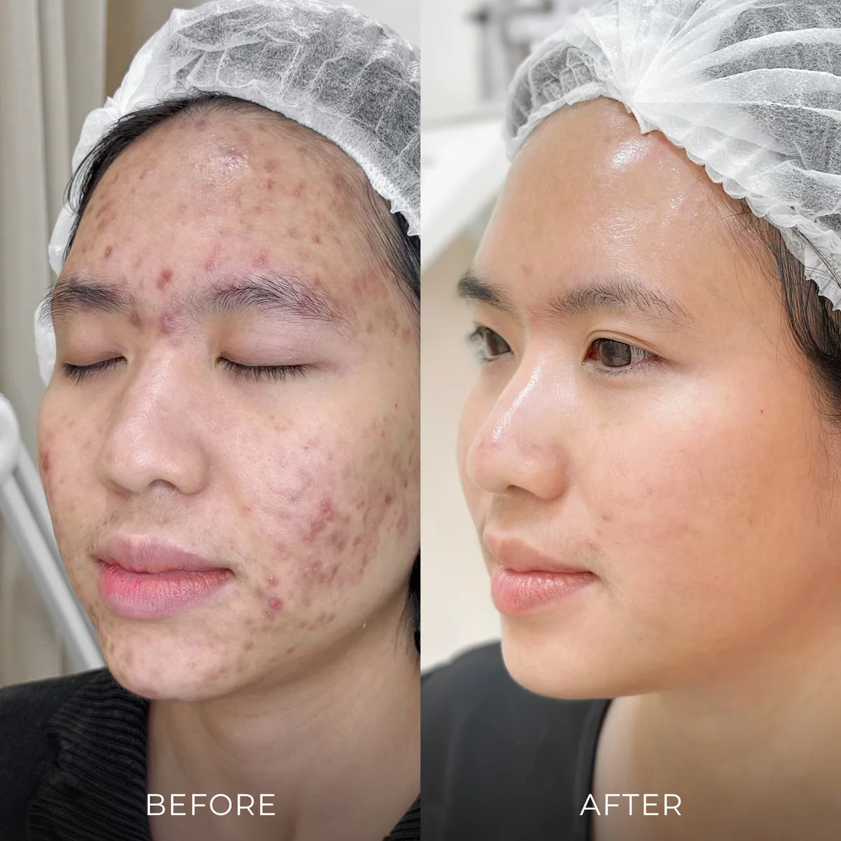 ภาพก่อน-หลังรักษาสิว Groove Skin Clinic เคส 08