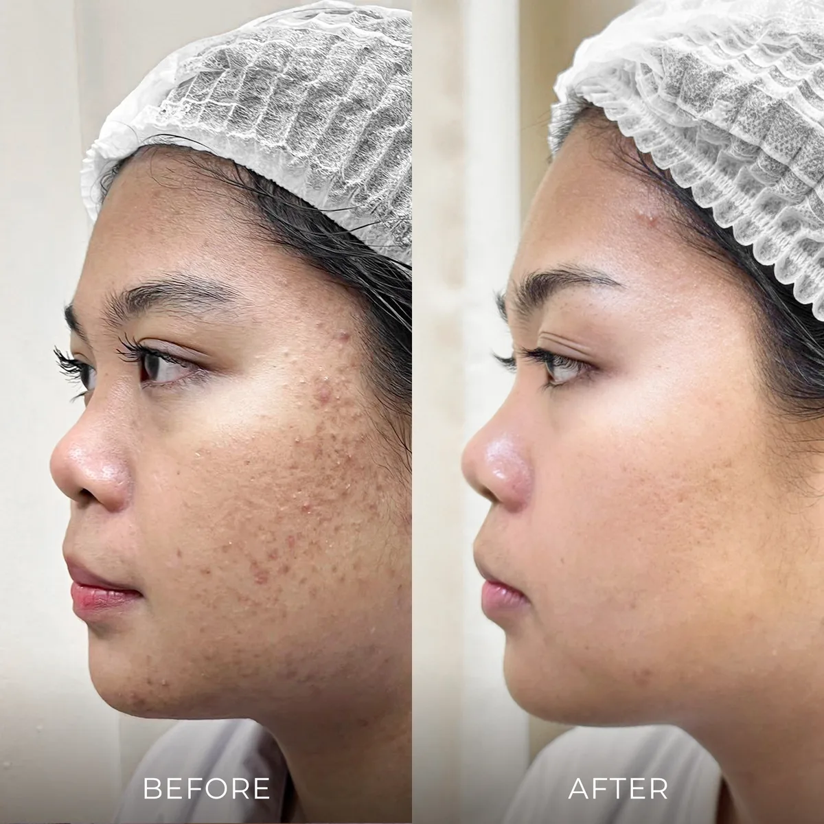 ภาพก่อน-หลังรักษาสิว Groove Skin Clinic เคส 09