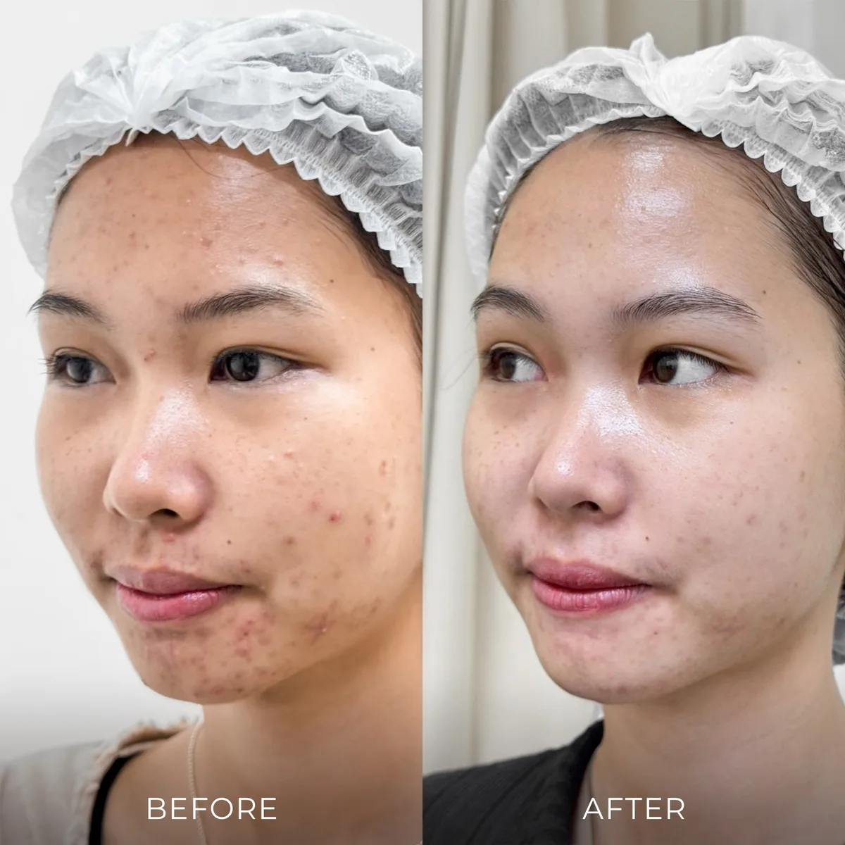 ภาพก่อน-หลังรักษาสิว Groove Skin Clinic เคส 10