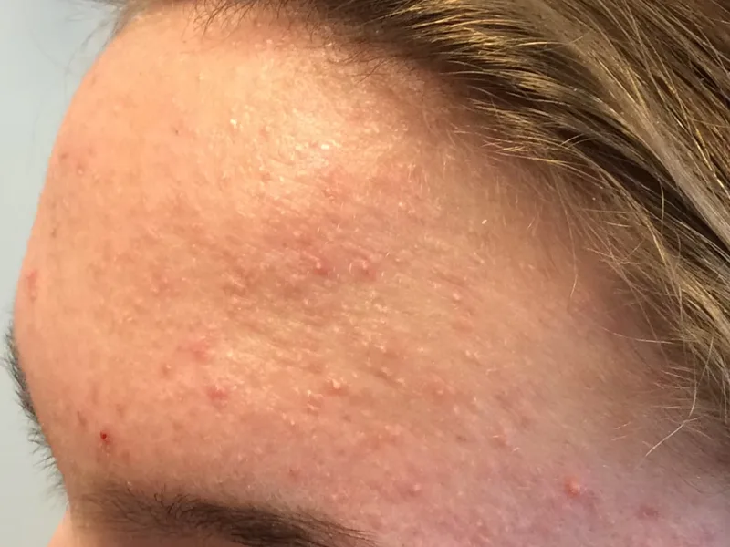 สิวผด (Fungal) (Fungal Acne) — Groove Skin Clinic สาขาม.เกษตร