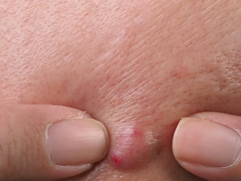 สิวตุ่มแดง (Papules) — Groove Skin Clinic สาขาม.เกษตร