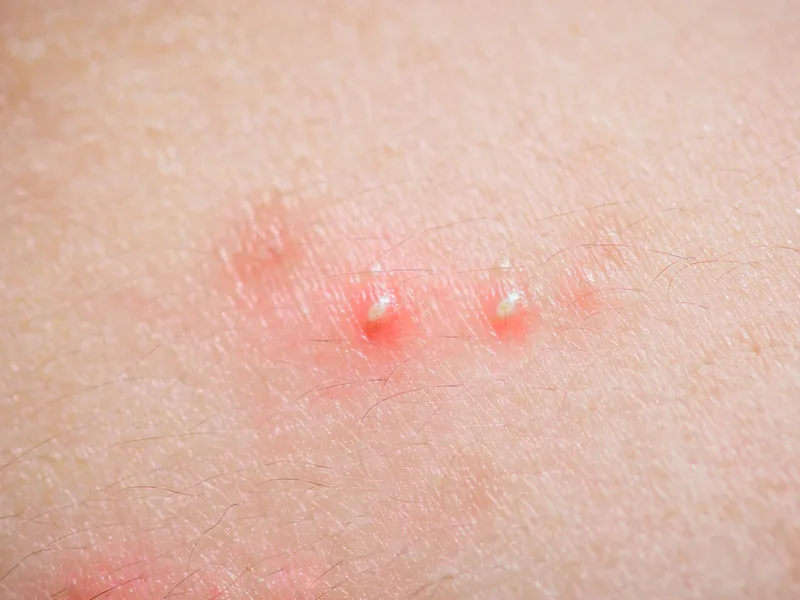 สิวหัวหนอง (Pustules) — Groove Skin Clinic สาขาม.เกษตร