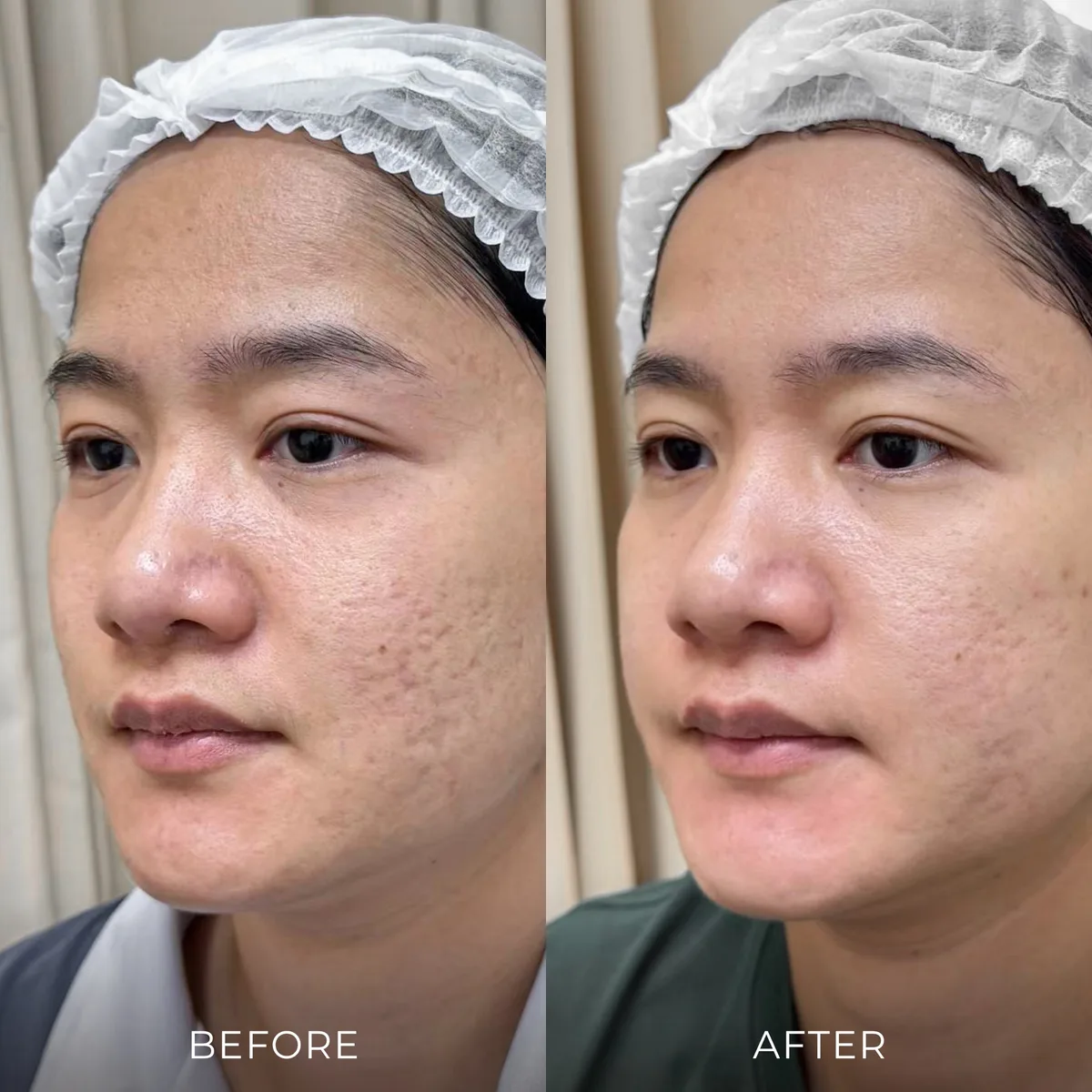 ภาพก่อน-หลังรักษาหลุมสิว Groove Skin Clinic เคส 01