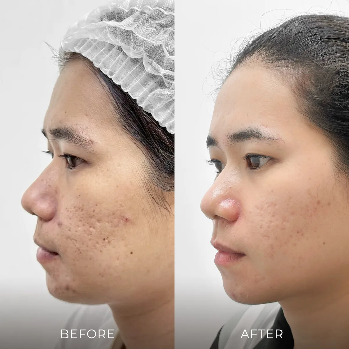 ภาพก่อน-หลังรักษาหลุมสิว Groove Skin Clinic เคส 02
