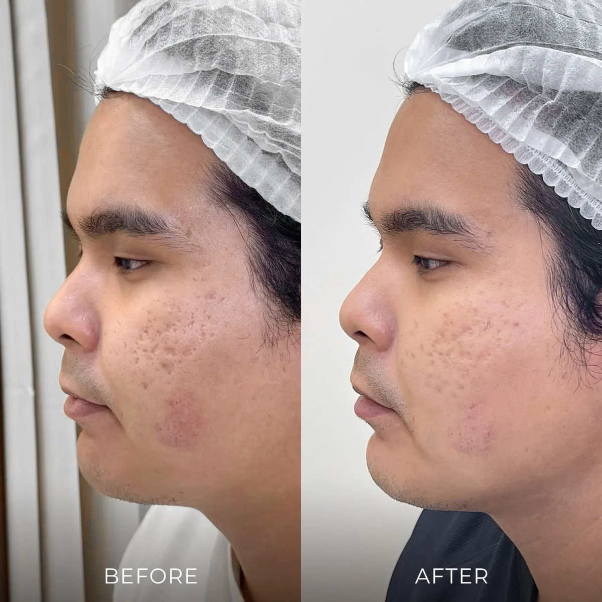 ภาพก่อน-หลังรักษาหลุมสิว Groove Skin Clinic เคส 03