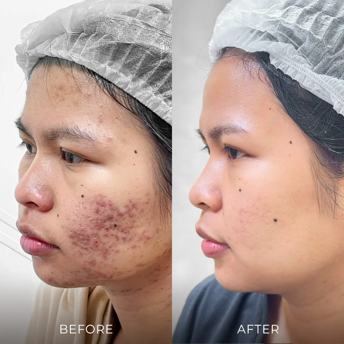 ภาพก่อน-หลังรักษาหลุมสิว Groove Skin Clinic เคส 04