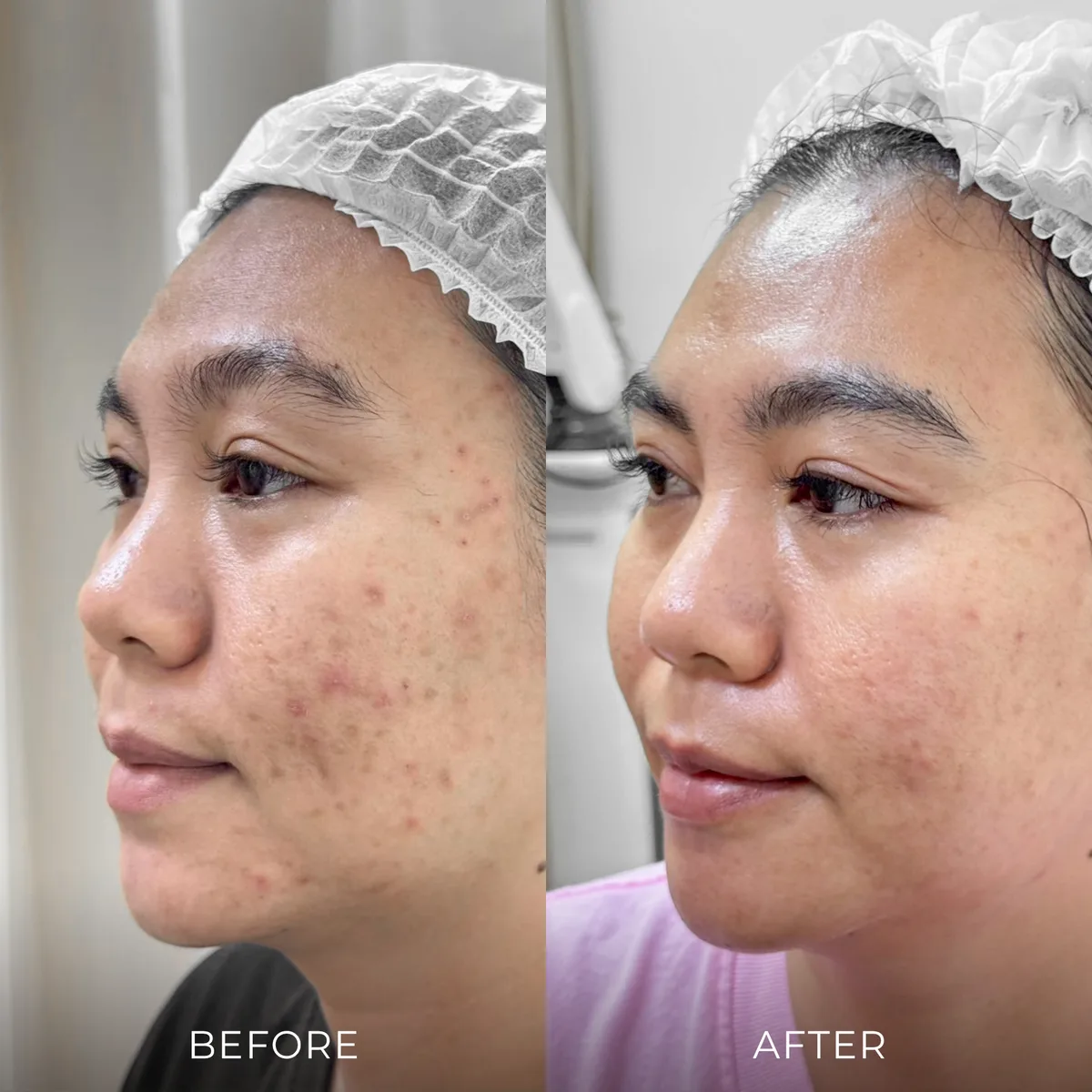 ภาพก่อน-หลังรักษาหลุมสิว Groove Skin Clinic เคส 05