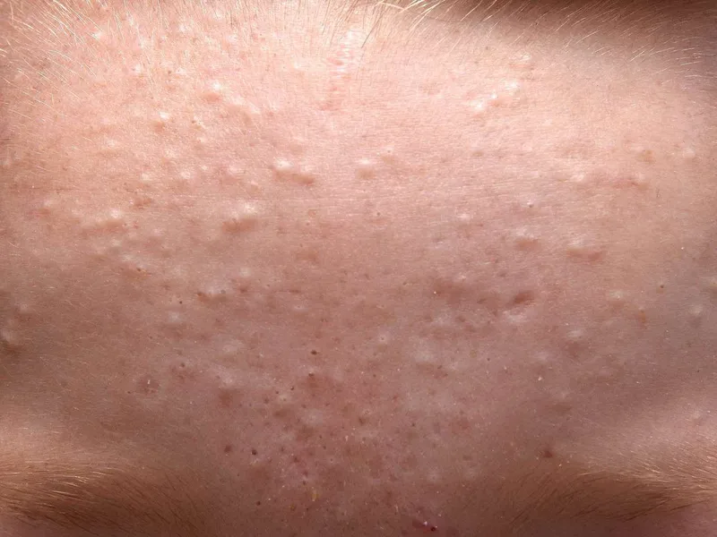 สิวอุดตัน/สิวหัวขาว (Whiteheads) — Groove Skin Clinic สาขาม.เกษตร