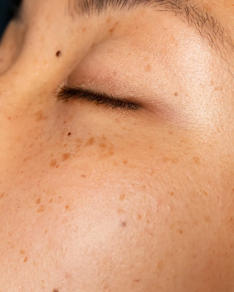 ฝ้า / กระ — Groove Skin Clinic