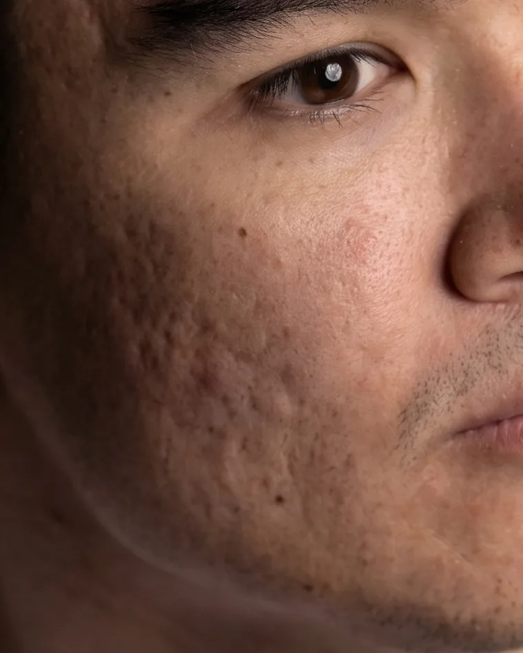 หลุมสิว — Groove Skin Clinic
