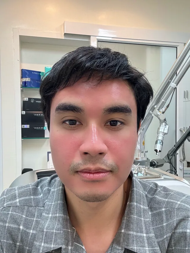 ผิวหลังทำ Pico Laser มีรอยแดงระเรื่อชั่วคราว — Groove Skin & Laser Clinic