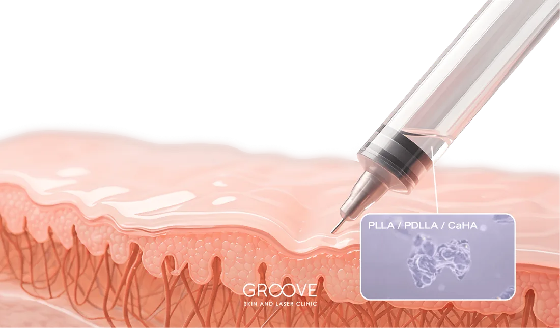 Biostimulator / rh-Collagen ฉีดกระตุ้นคอลลาเจนหนุนก้นหลุม — Groove Skin & Laser Clinic