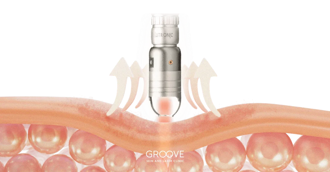 Picosecond Laser รักษาหลุมสิวด้วยปรากฏการณ์ LIOB — Groove Skin & Laser Clinic