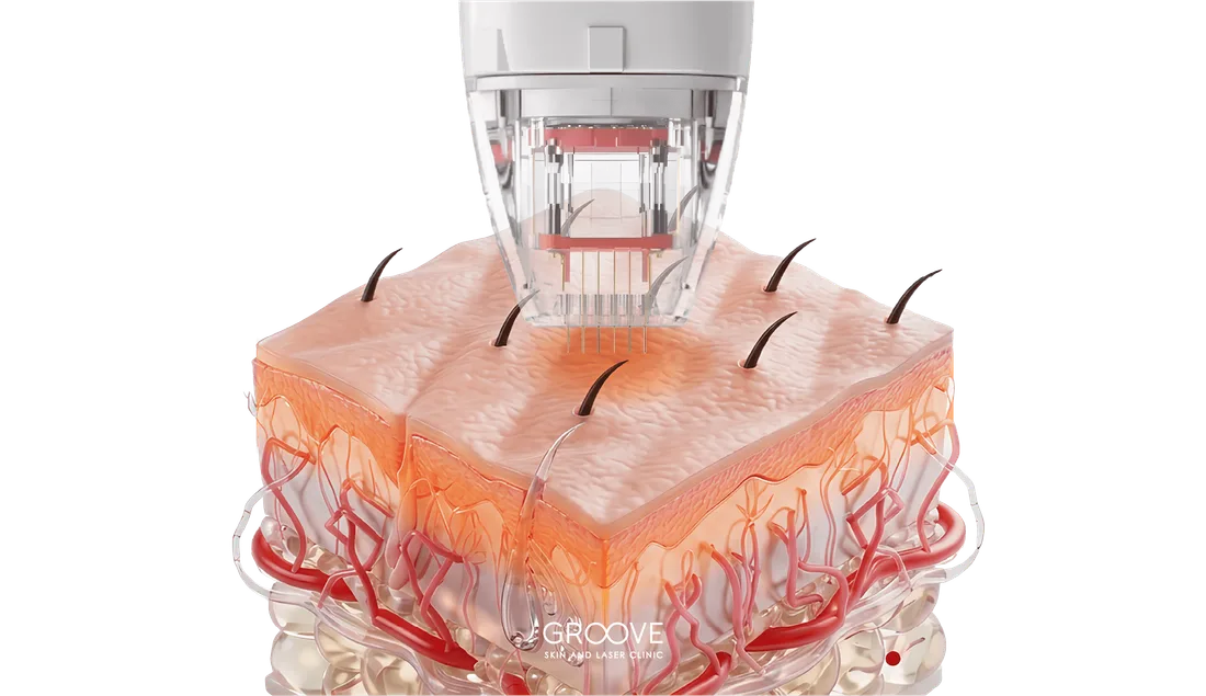 RF Microneedle เข็มปล่อยพลังงานคลื่นวิทยุใต้ผิว — Groove Skin & Laser Clinic