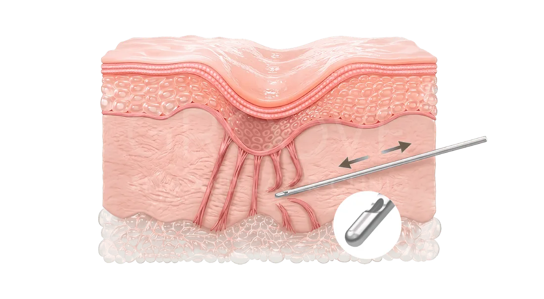 Subcision เซาะพังผืดด้วยเข็มปลายทู่ Blunt Cannula — Groove Skin & Laser Clinic